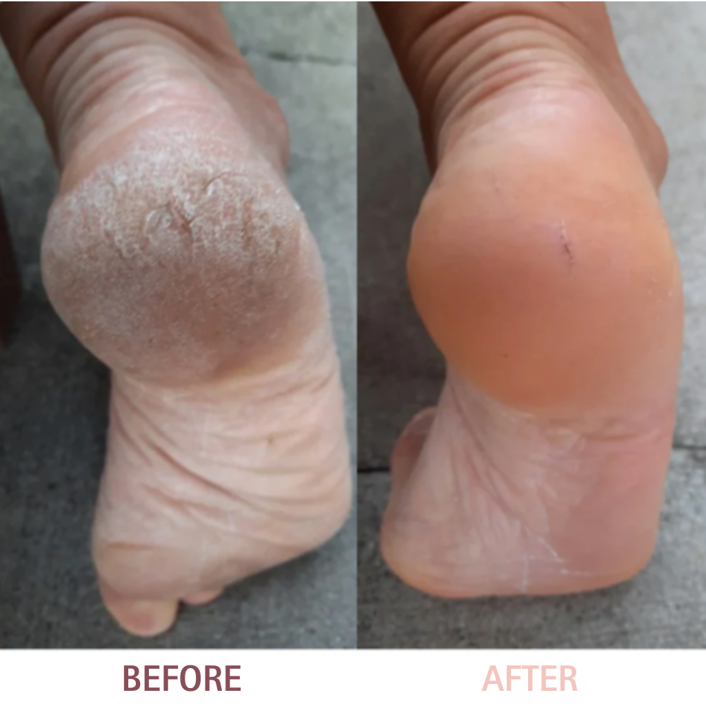 Foot Fix™ Callus Remover